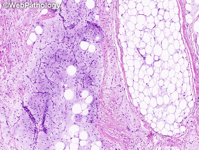 Soft Tissue_Lipomatous_Lipoblastoma34_resized.jpg